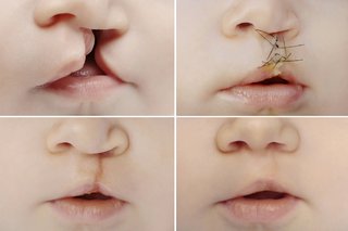 How do you care for a newborn with a cleft lip?