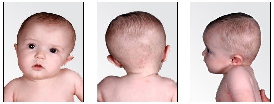 Cách chữa vẹo cổ ở trẻ sơ sinh