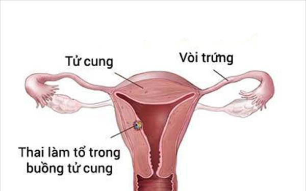 Dấu hiệu thai đã vào tử cung - có thể nhận biết sớm