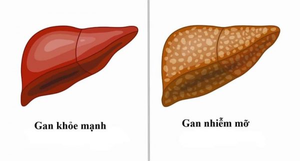 Nguyên nhân bệnh gan nhiễm mỡ