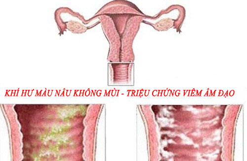 Khí hư có màu nâu - Triệu chứng của bệnh viêm âm đạo