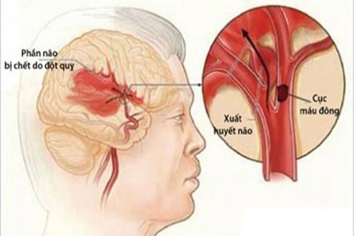 Cục máu đông - Nguyên nhân chính dễ dẫn tới đột quỵ.